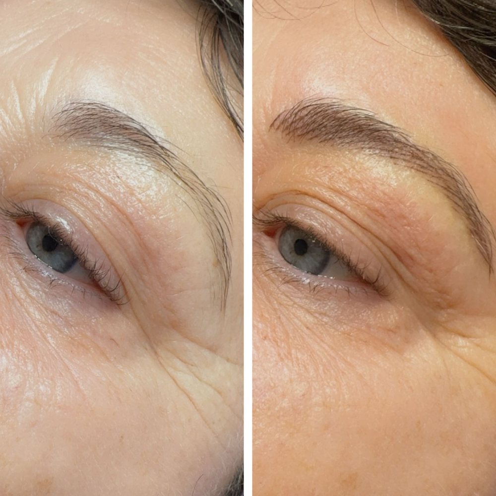 Brow before, left, and after, right